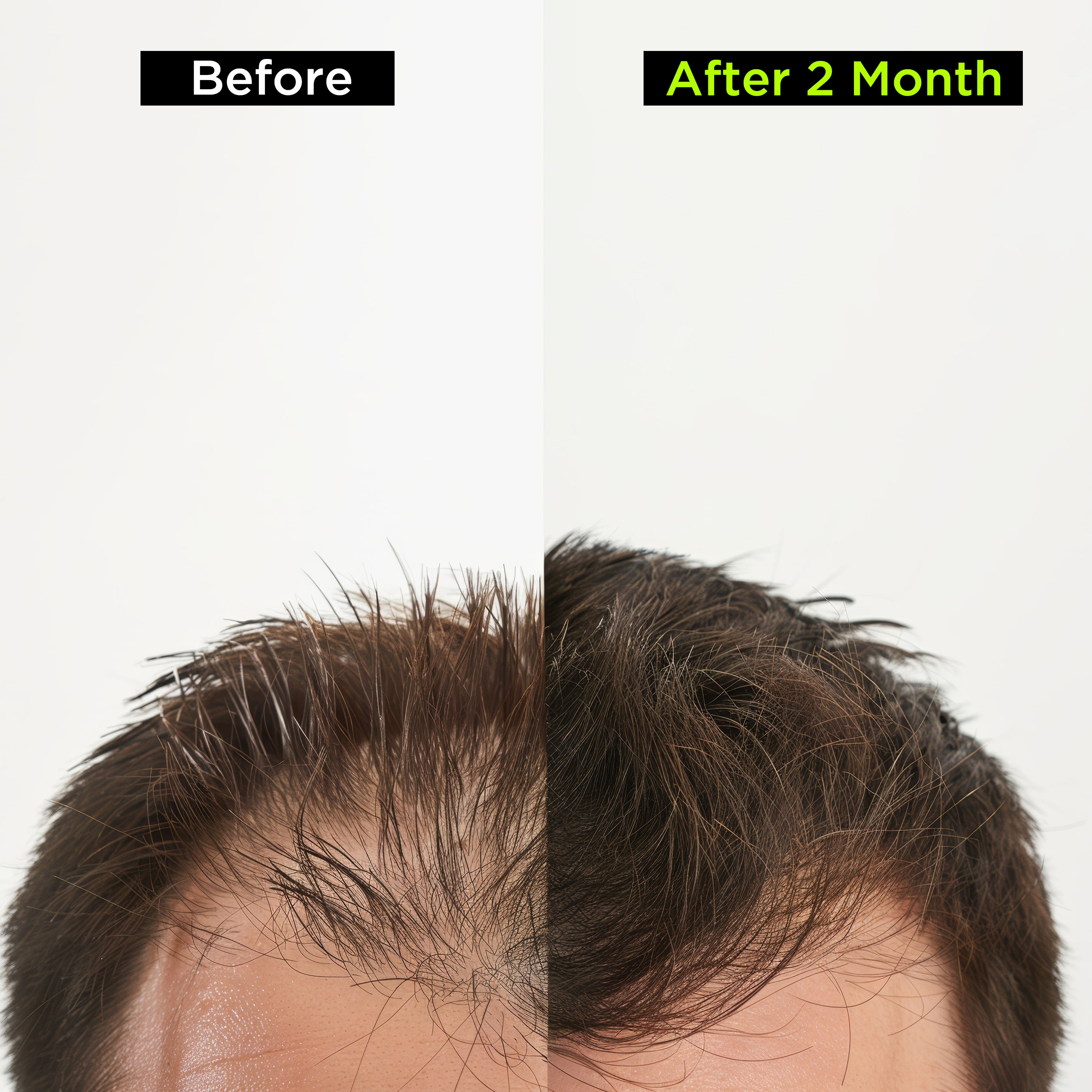 Health Veda Organics Advance Hair Vitamin with DHT Blocker & Biotin | Clinically proven Hair Vitamins For Men & Women - 60 Veg Capsules